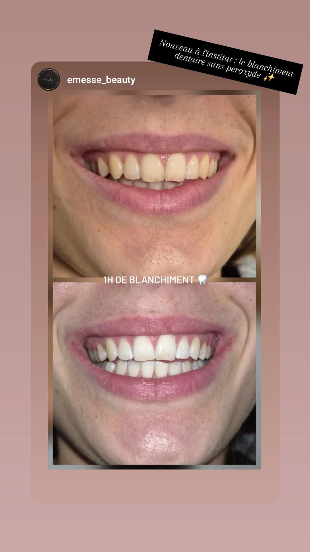 Blanchiment dentaire